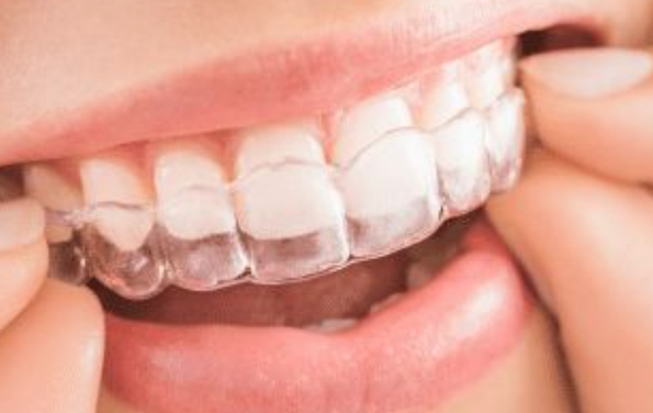 Invisalign Orthodontic Aligner